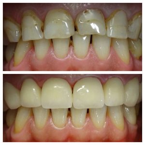 facings veneers tanden tandarts hongarije boedapest