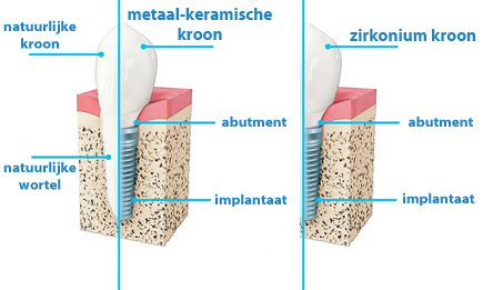 implantaat-kroon-of-implantaat-zirkonium-kroon-prijs-kosten-ervaringen-Hongarije-Boedapest-TopTanden-goedkoop