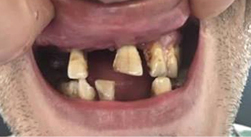 all-on-6 zirkonium vast gebit op tandimplantaten toptanden mondzorg hongarije voorfoto
