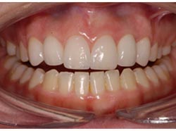 Na Foto implantaat tand bij-missen-van 2 of meer tanden tandarts mondzorg hongarije boedapest toptanden